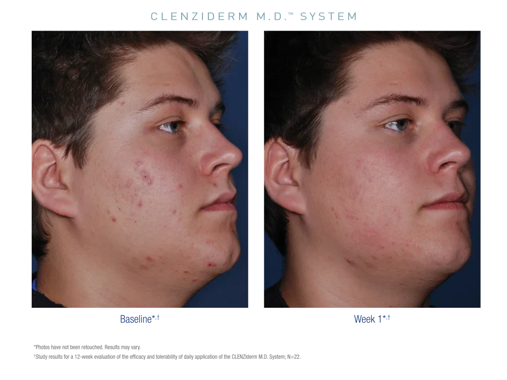 CLENZIderm M.D. Therapeutic Lotion 5% BPO 47ml - Image 7