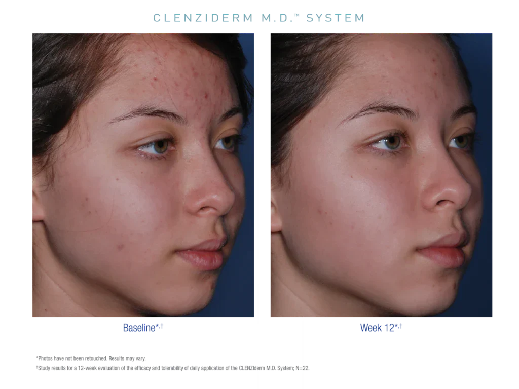 CLENZIderm M.D. Therapeutic Lotion 5% BPO 47ml - Image 8