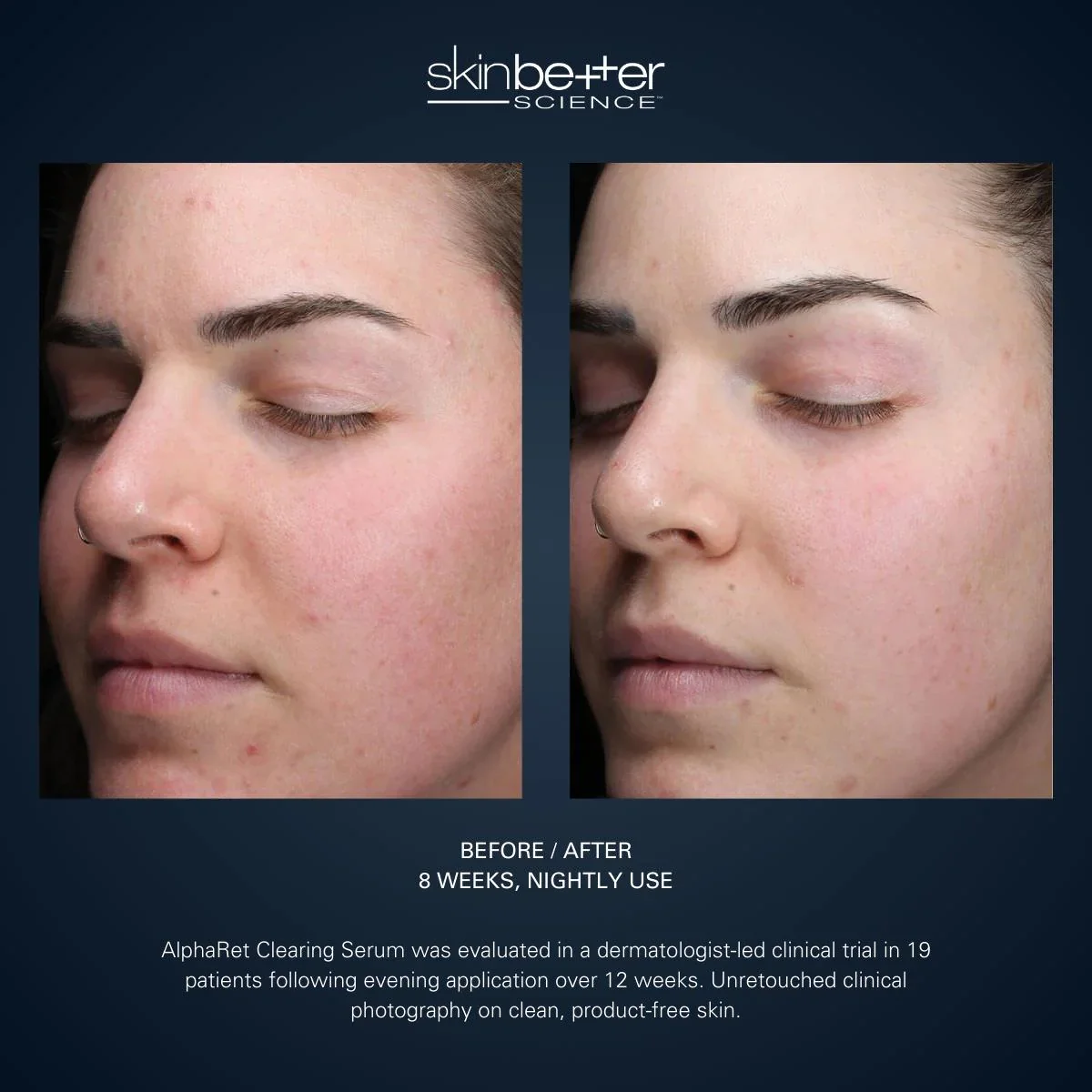 Alpharet Clearing Serum 30ml - Image 4